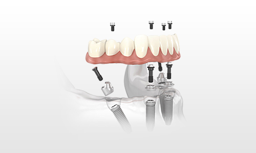 All-on-4, teeth in a day, all on four - enquire today about our same day teeth service in Scotland