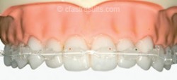 tooth_alignment_triodent