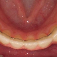 orthodontic fixed retainer Inverness