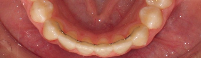 orthodontic fixed retainer Inverness